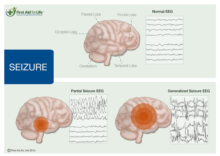 Febrile Convulsions