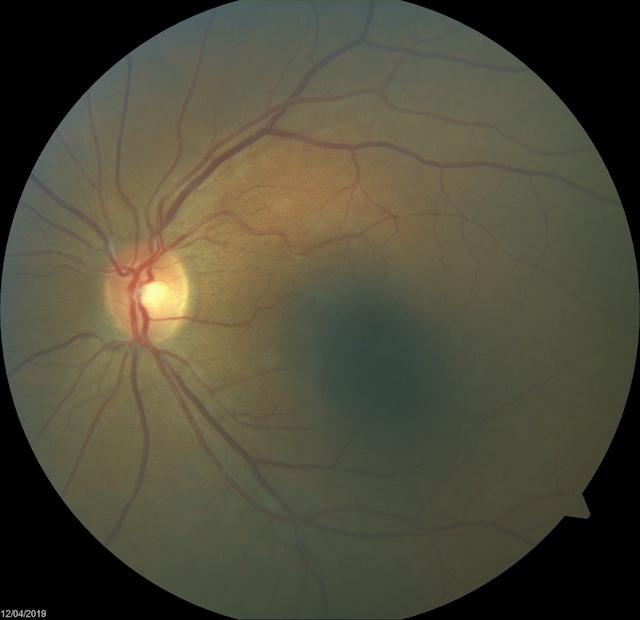 eye exam image of the inside of an eye