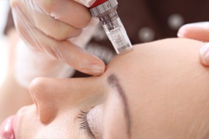 reasons to try microneedling