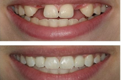 dental implant
