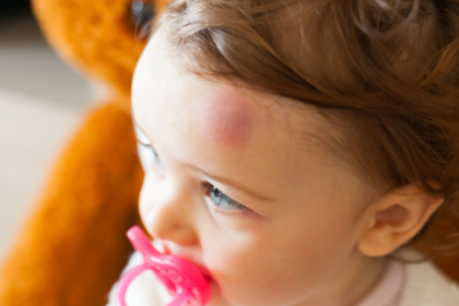 toddler with a bruise