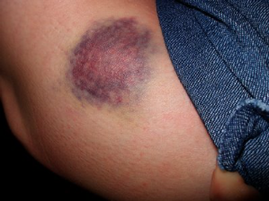 First aid for toddlers bruise