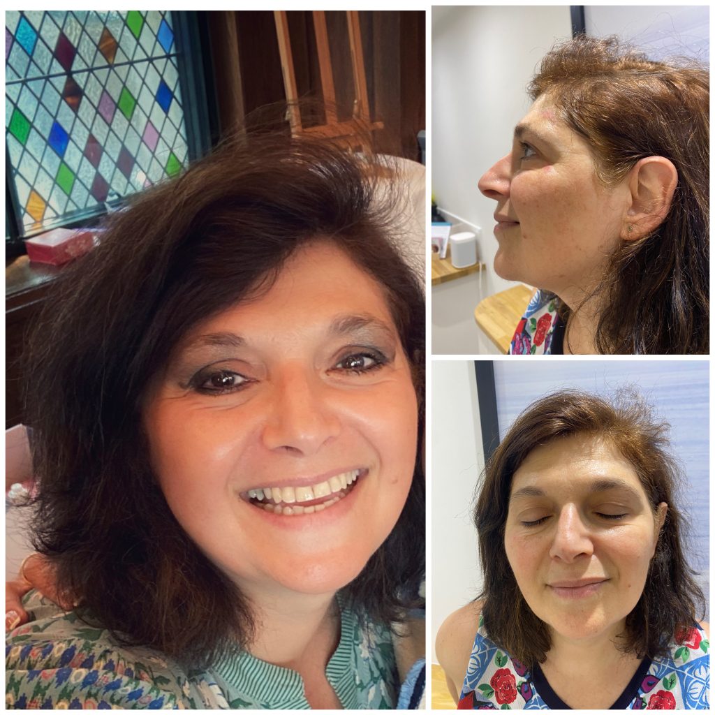 laser facial skinlaundry