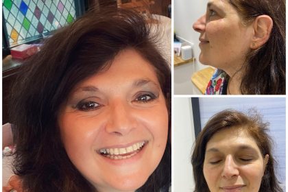 laser facial skinlaundry